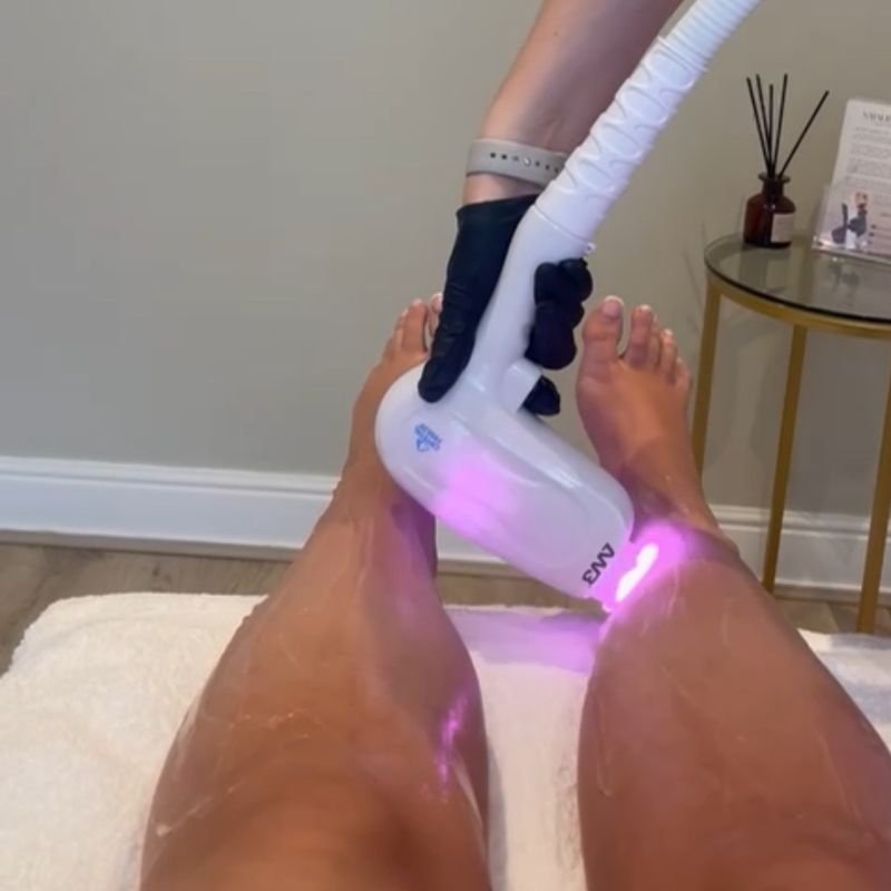 Image of cients leg having laser hair removal at Natalie Anne Laser Barnsley